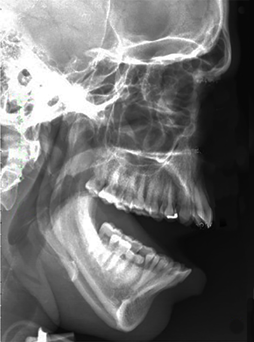 X-Ray demonstrates temporomandibular joint dislocation.
